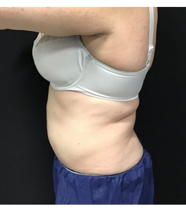 After Image: CoolSculpting – Abdomen - front