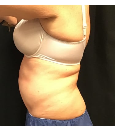 Before Image: CoolSculpting – Abdomen - front