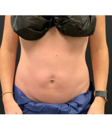 After Image: CoolSculpting – Abdomen - front