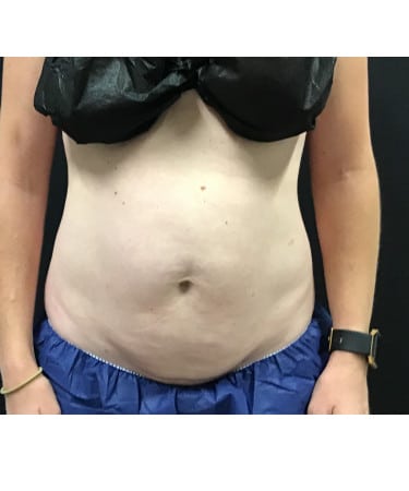 Before Image: CoolSculpting – Abdomen - front