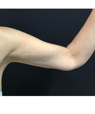After Image: CoolSculpting – Arms