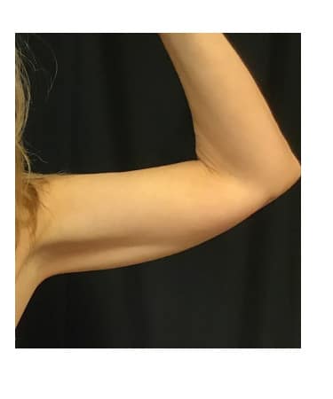 Before Image: CoolSculpting – Arms