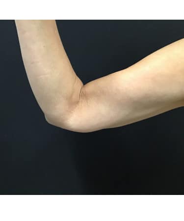 After Image: CoolSculpting – Arms - right-side