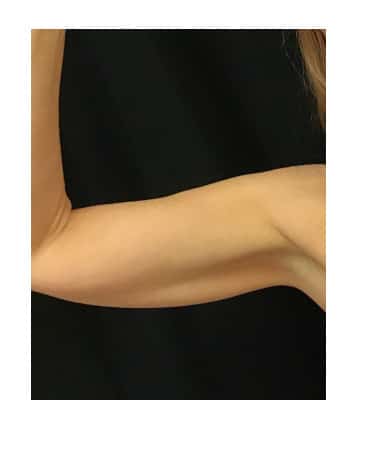 Before Image: CoolSculpting – Arms - right-side