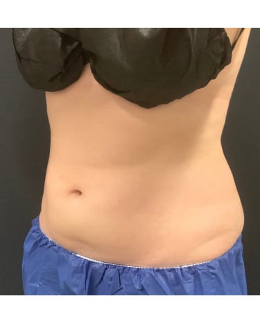 After Image: CoolSculpting – Abdomen & Flanks - left-front-oblique