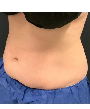 Before Image: CoolSculpting – Abdomen & Flanks - left-front-oblique