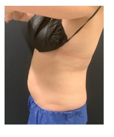 After Image: CoolSculpting – Abdomen & Flanks - left-side