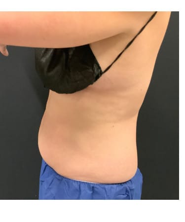 Before Image: CoolSculpting – Abdomen & Flanks - left-side