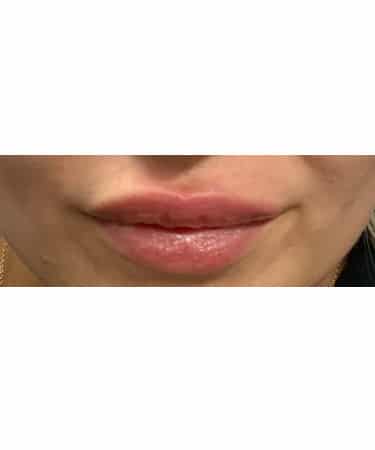 Dermal Filler – Versa (lips)