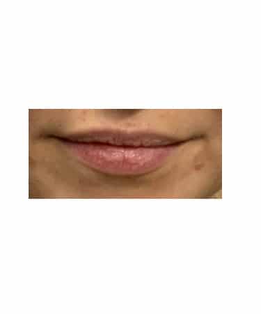 Dermal Filler – Versa (lips)