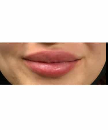 After Image: Dermal Filler – Versa (lips) - front