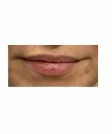 Before Image: Dermal Filler – Versa (lips) - front